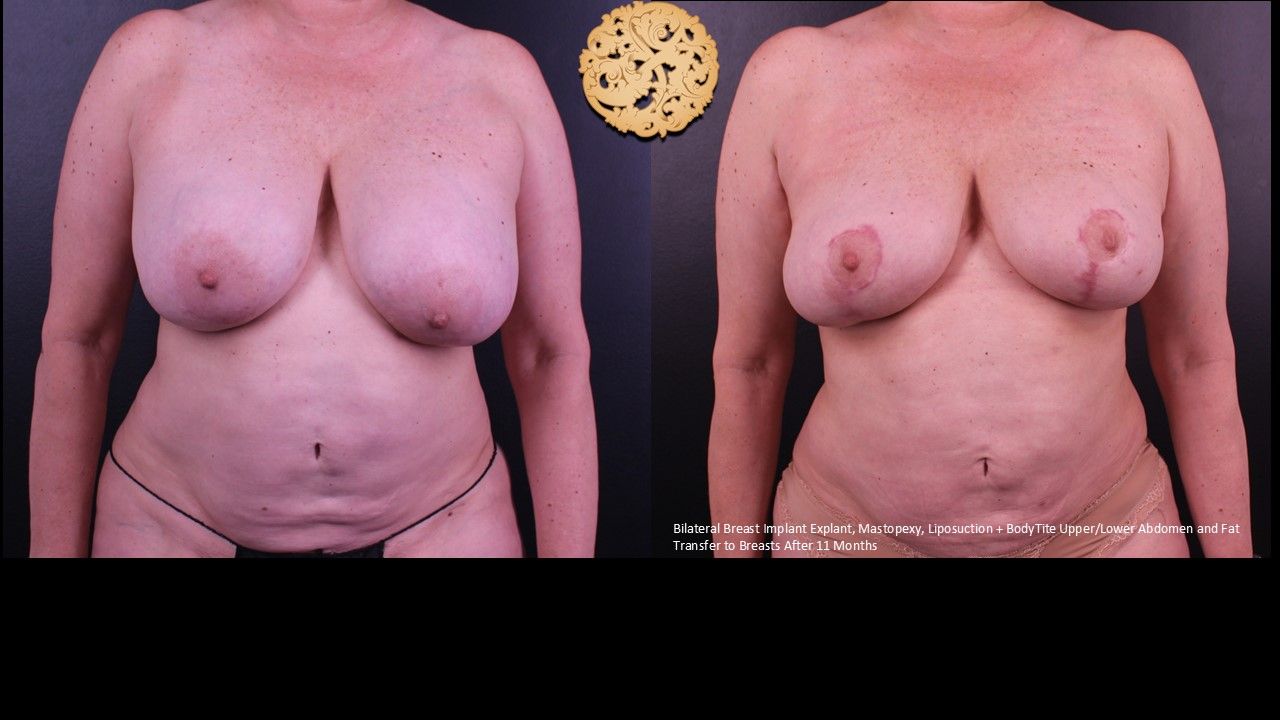 Breast Implant Removal Before & After