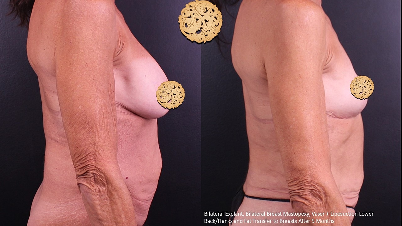 Breast Explant (Implant Removal) Before & After