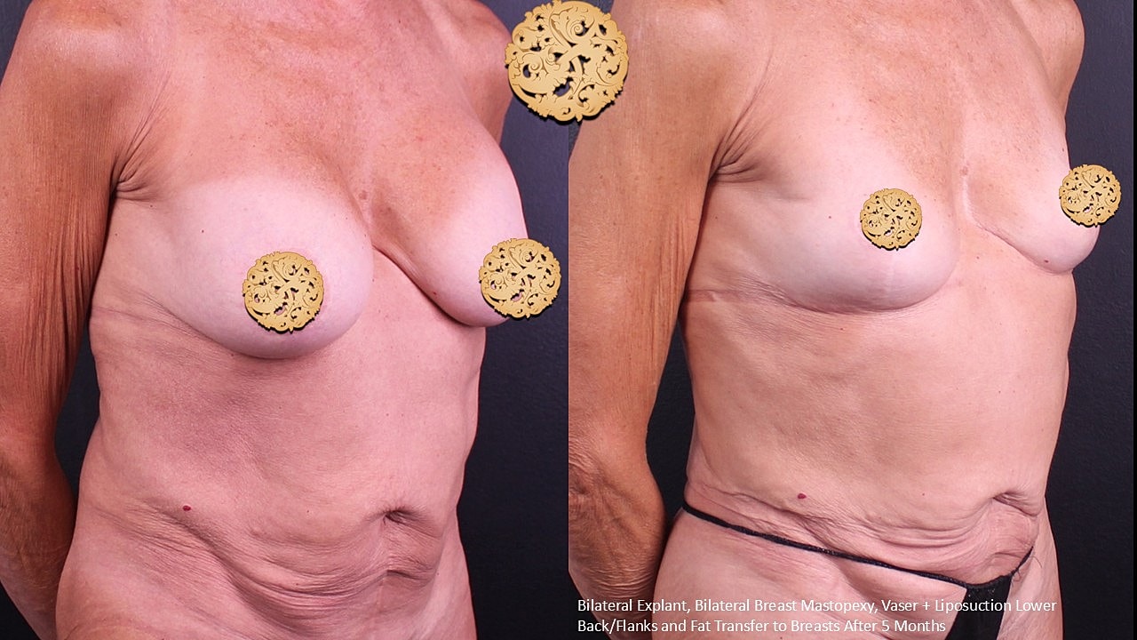 Breast Explant (Implant Removal) Before & After