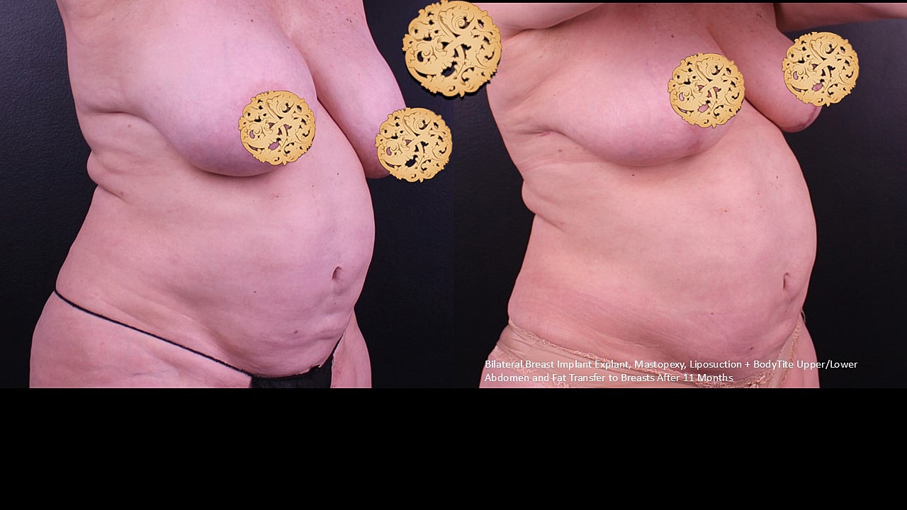 Breast Explant (Implant Removal) Before & After