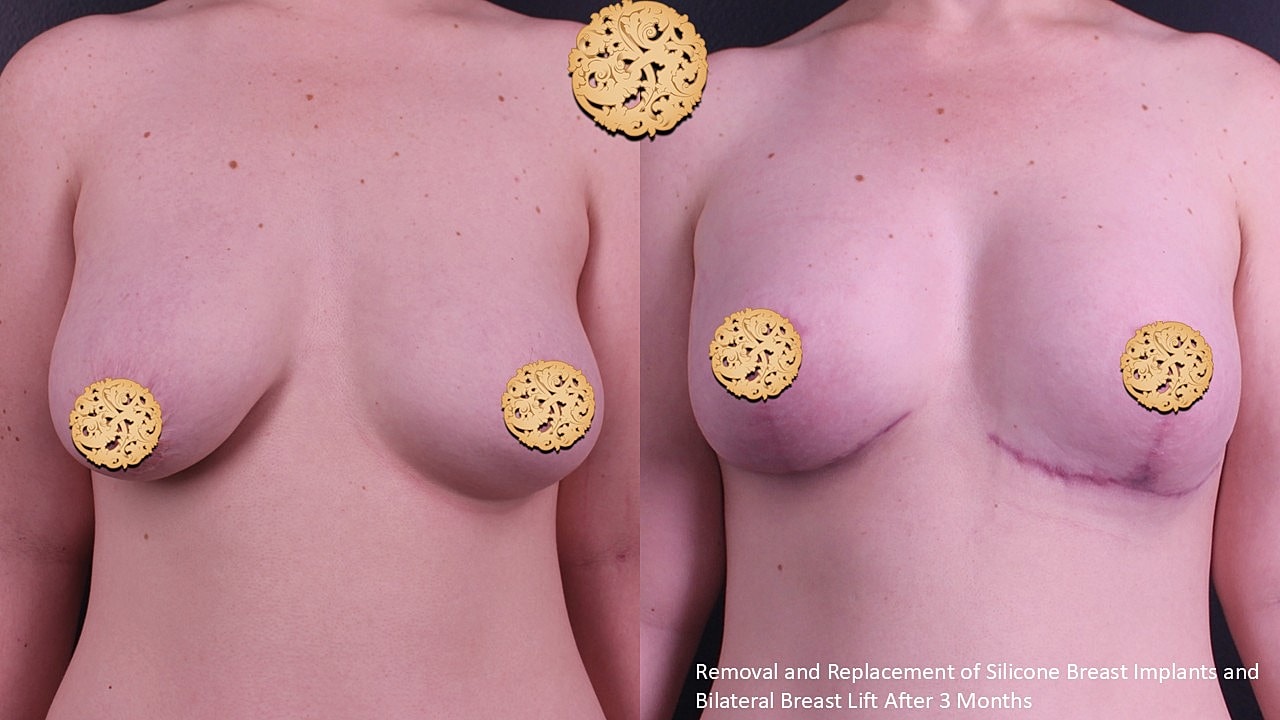 Breast Implant Removal Before & After
