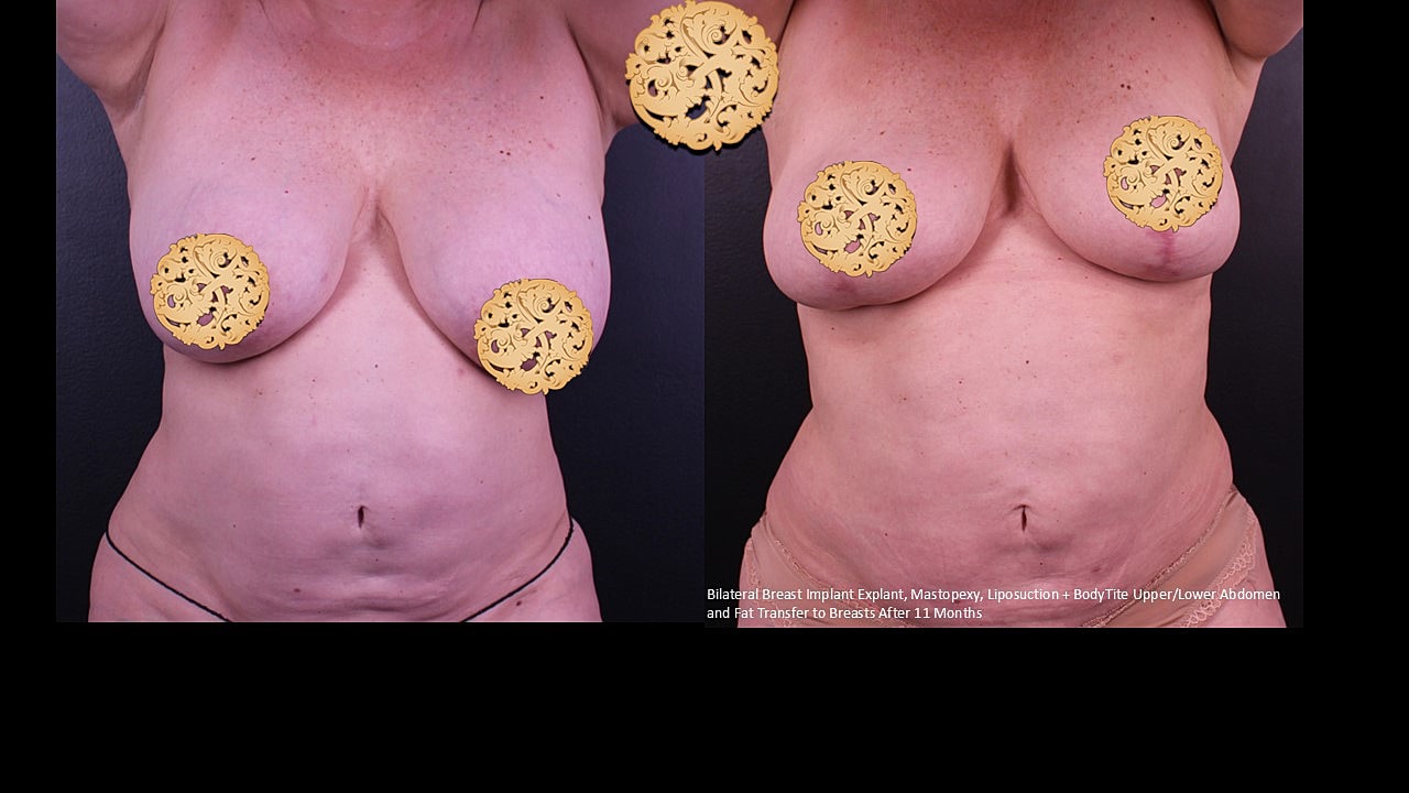 Breast Explant (Implant Removal) Before & After