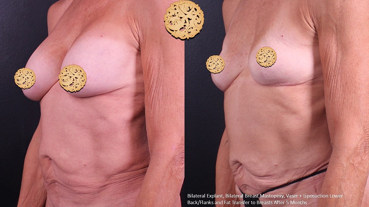 Breast Explant (Implant Removal) Before & After