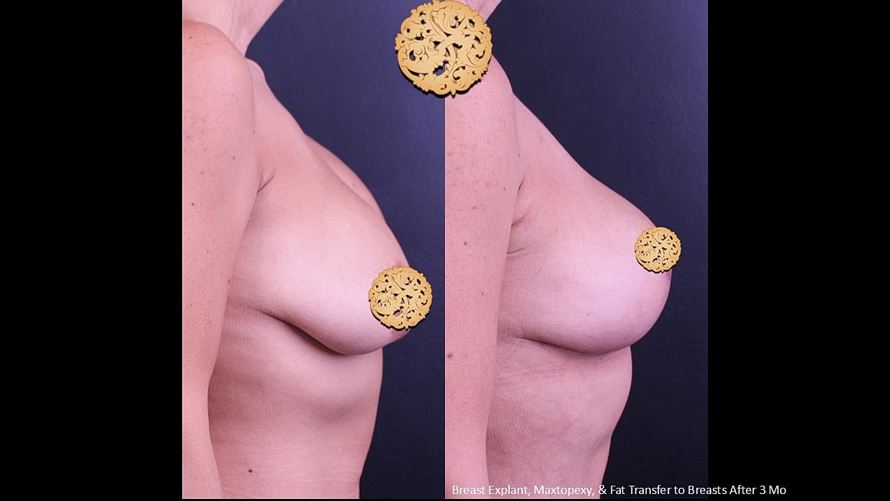 Breast Explant (Implant Removal) Before & After