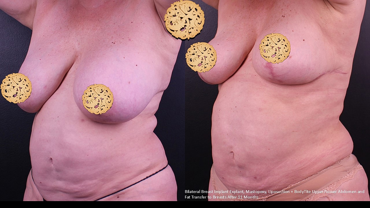Breast Explant (Implant Removal) Before & After