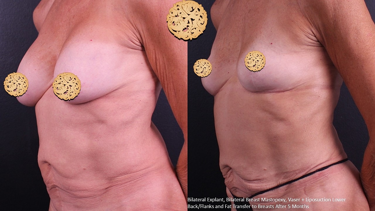 Breast Explant (Implant Removal) Before & After