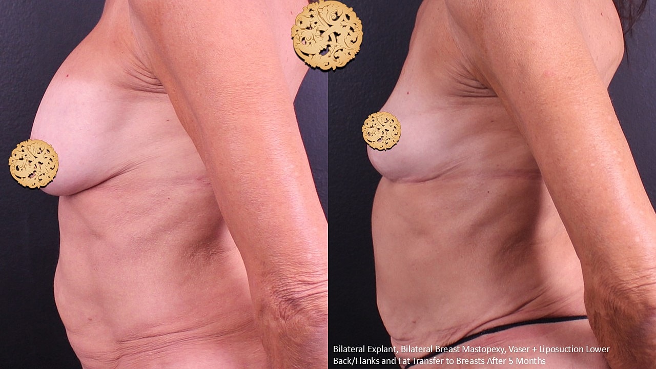 Breast Explant (Implant Removal) Before & After