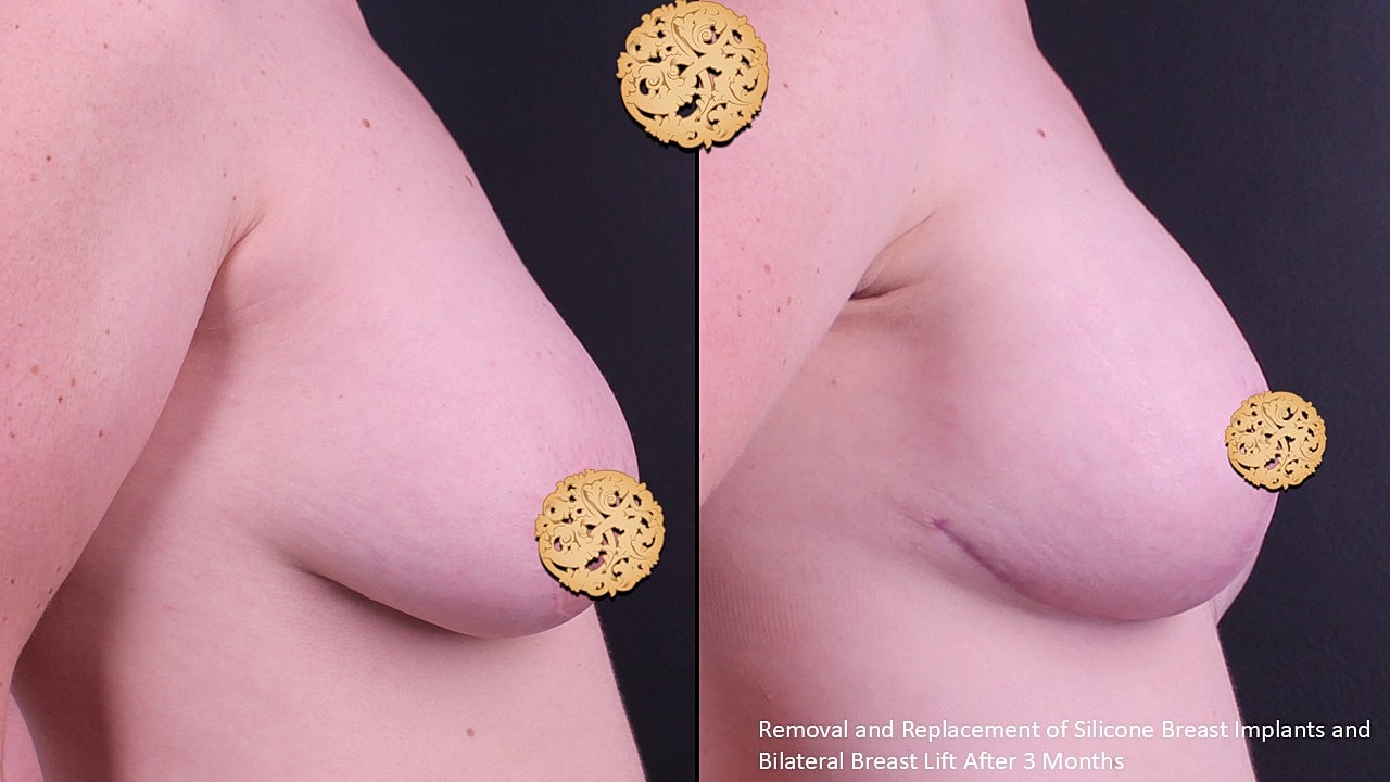 Breast Implant Removal Before & After