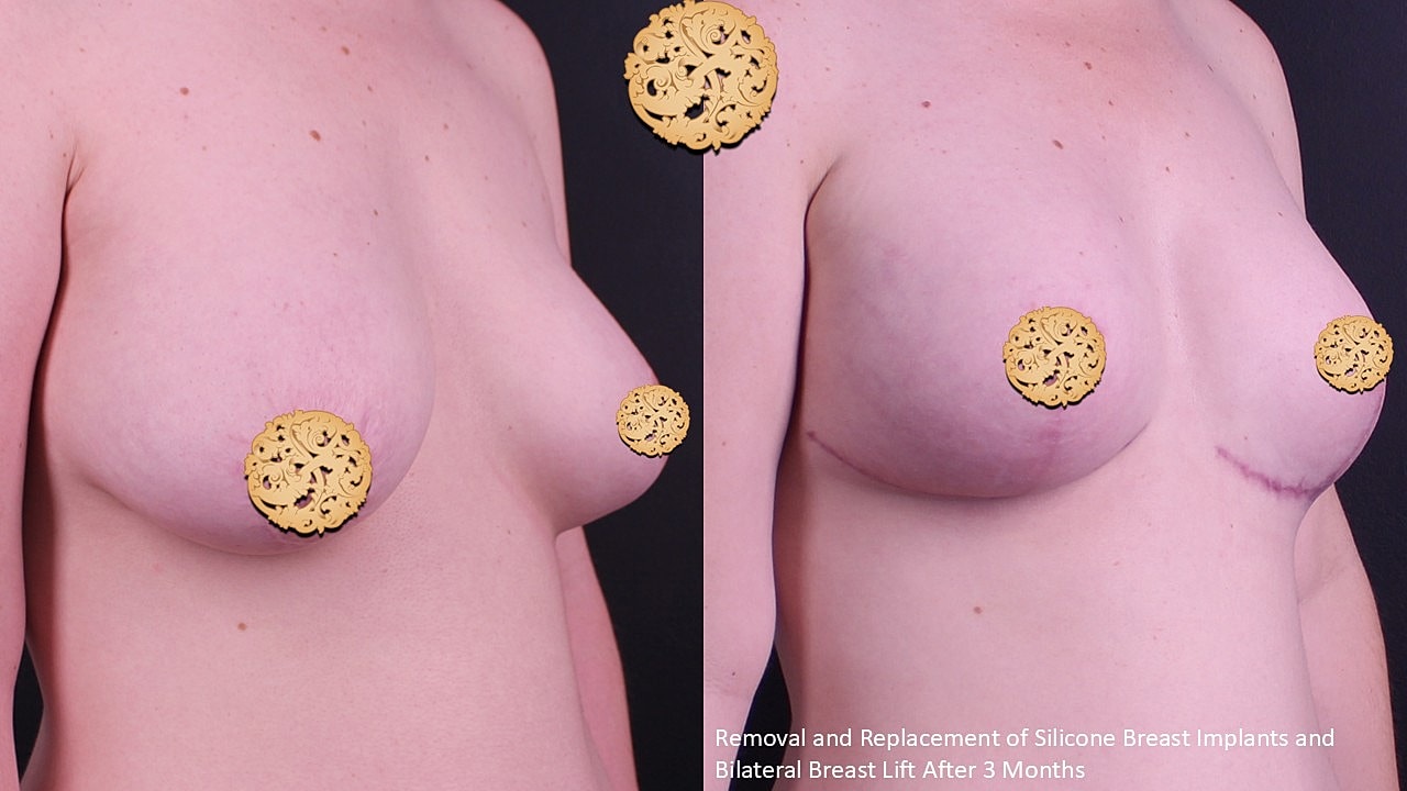 Breast Implant Removal Before & After