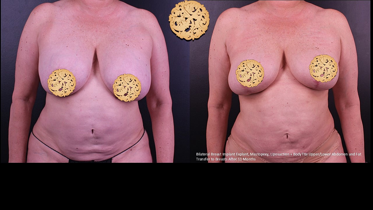 Breast Explant (Implant Removal) Before & After