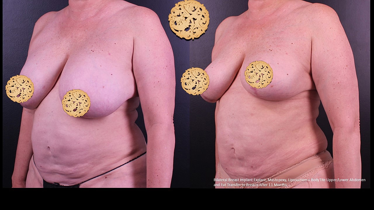 Breast Explant (Implant Removal) Before & After