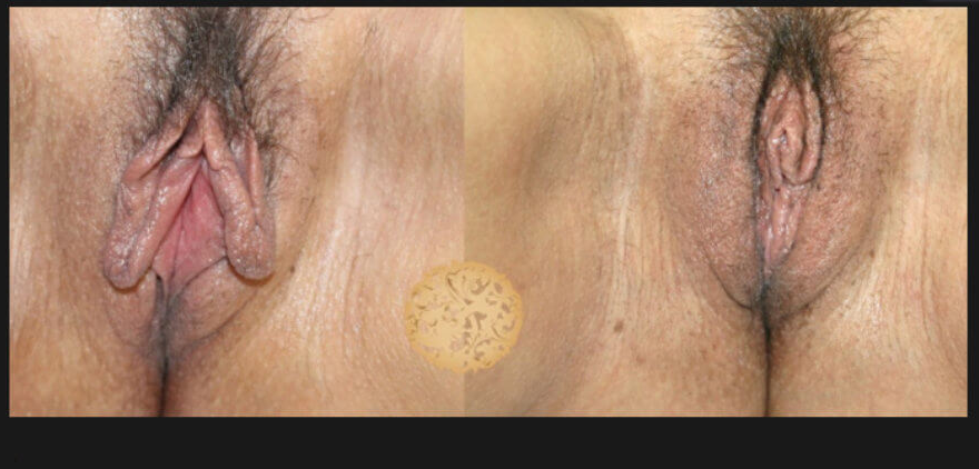 Labiaplasty Before & After