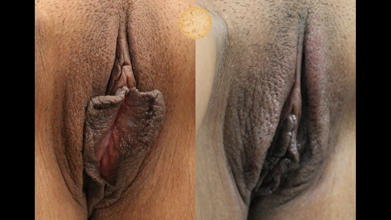 Labiaplasty Before & After