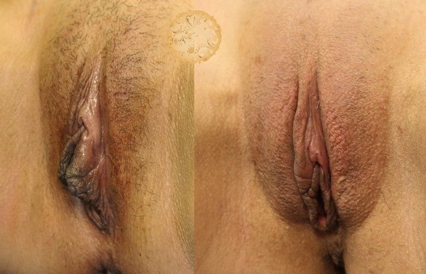 Labiaplasty Before & After