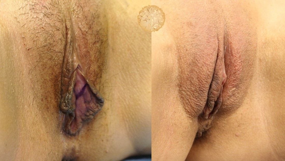 Labiaplasty Before & After