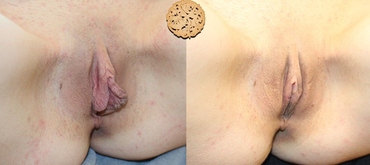 Labiaplasty Before & After