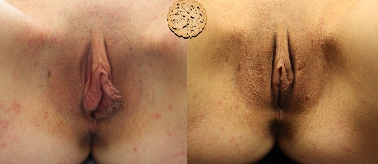 Labiaplasty Before & After