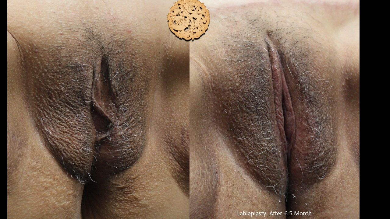Labiaplasty Before & After