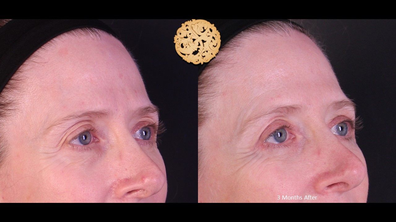 Blepharoplasty Before & After