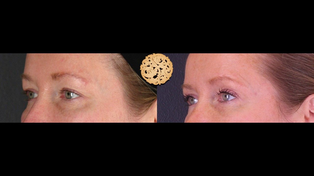 Blepharoplasty Before & After