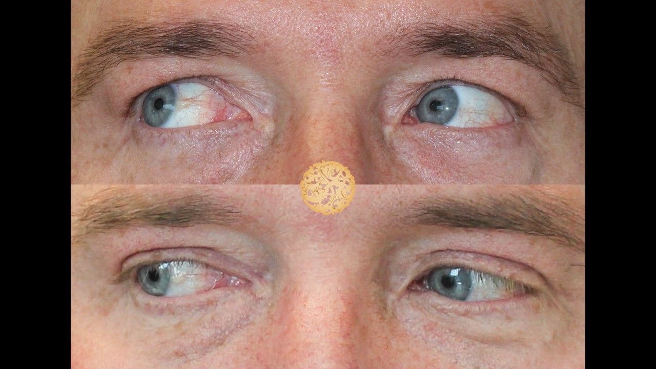 Blepharoplasty Before & After