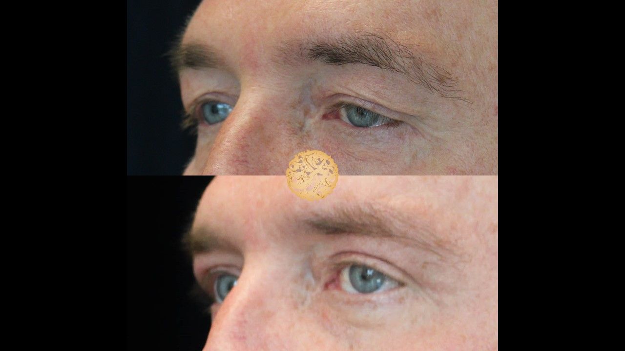 Blepharoplasty Before & After