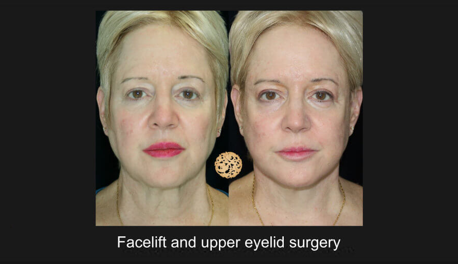 Blepharoplasty Before & After