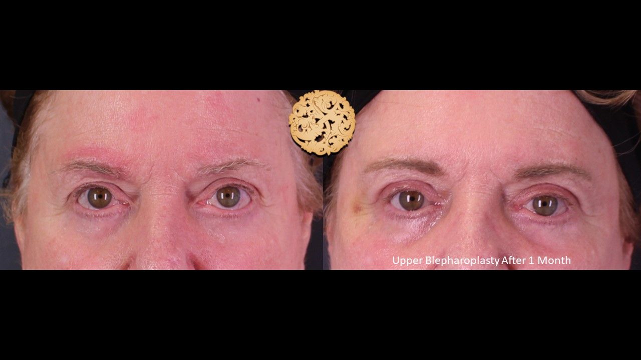 Blepharoplasty Before & After