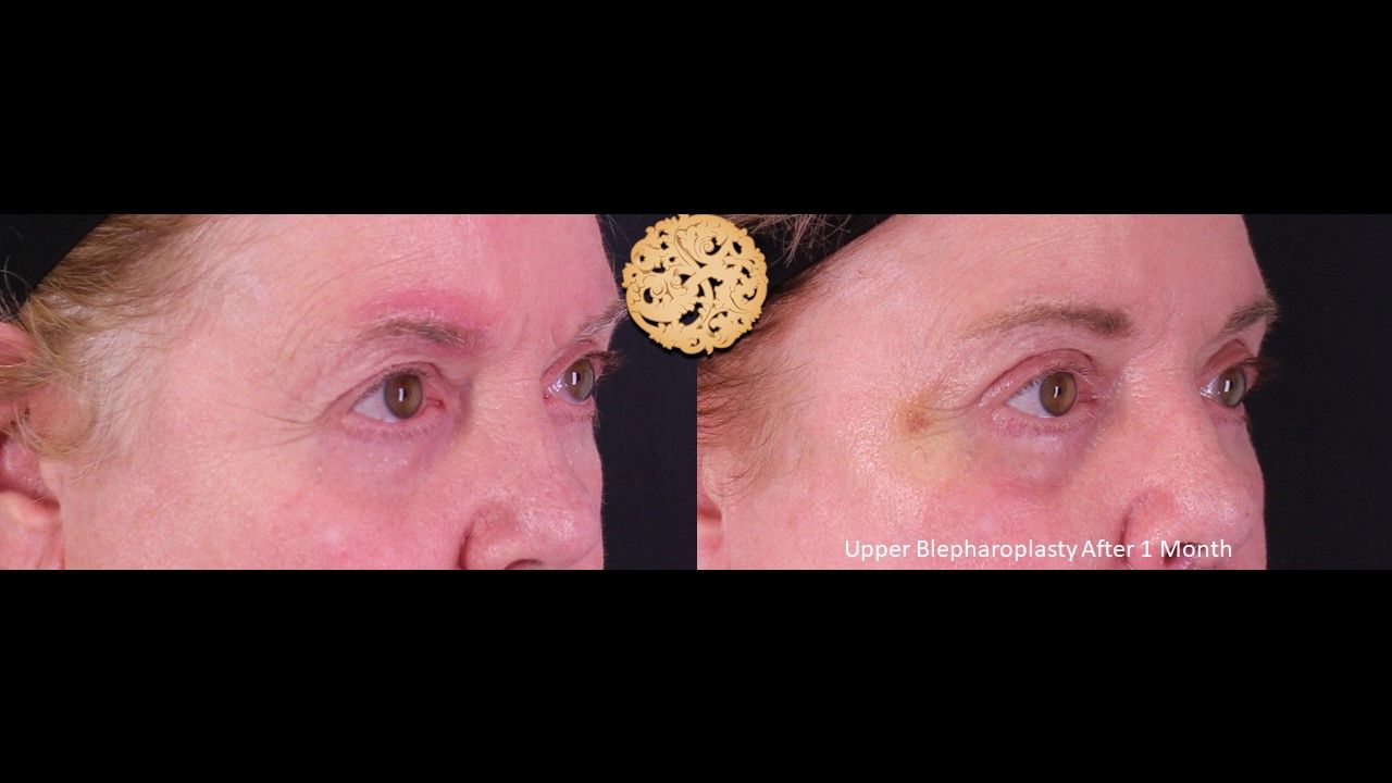 Blepharoplasty Before & After