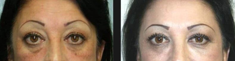 Blepharoplasty Before & After