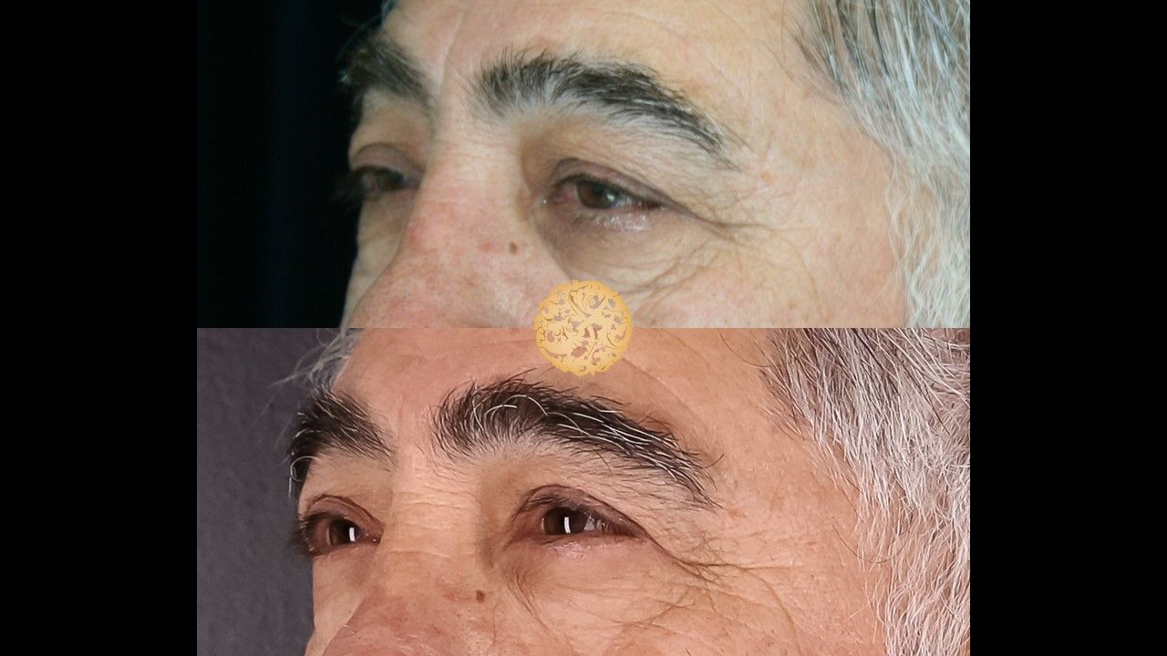 Blepharoplasty Before & After