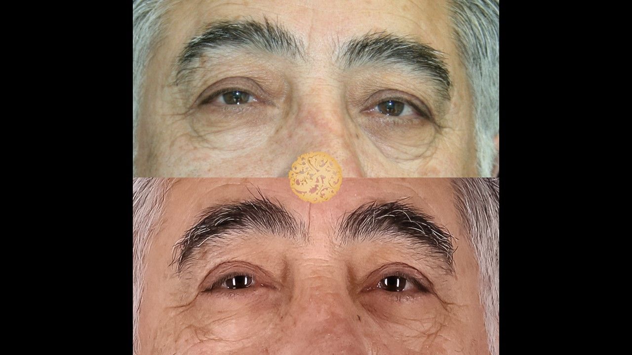 Blepharoplasty Before & After