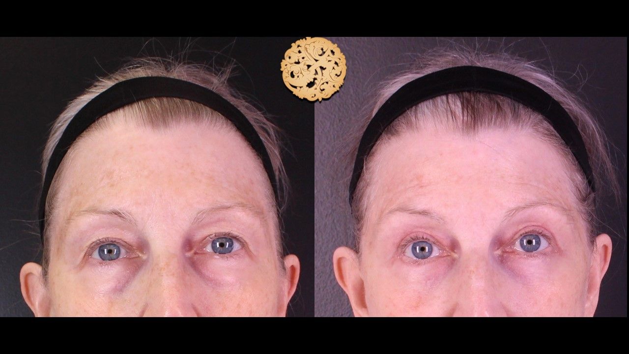 Blepharoplasty Before & After