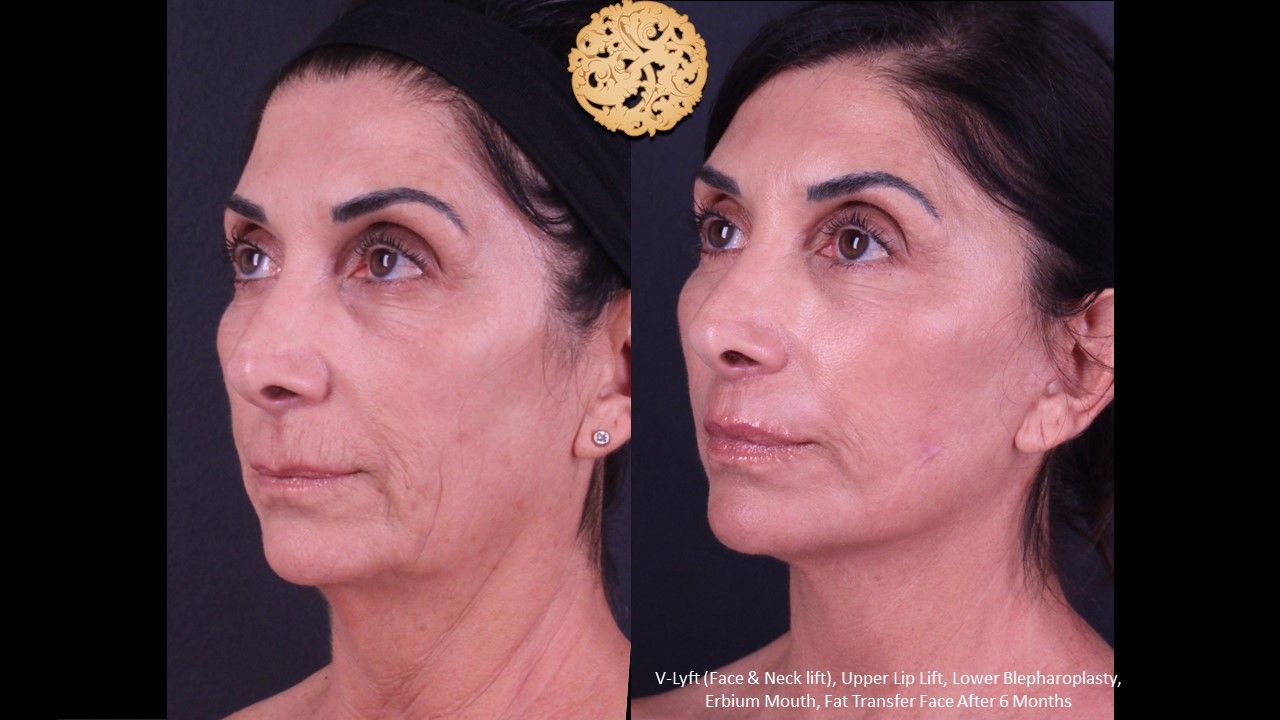 Blepharoplasty Before & After