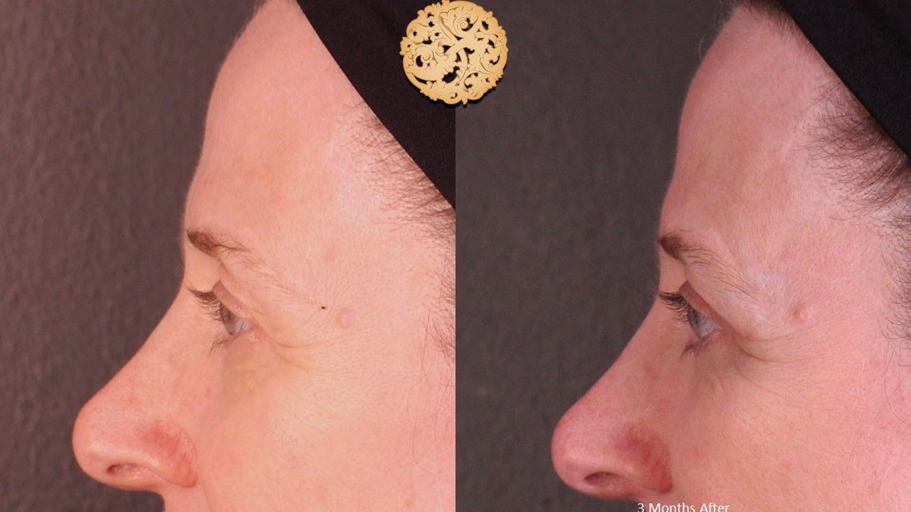 Blepharoplasty Before & After