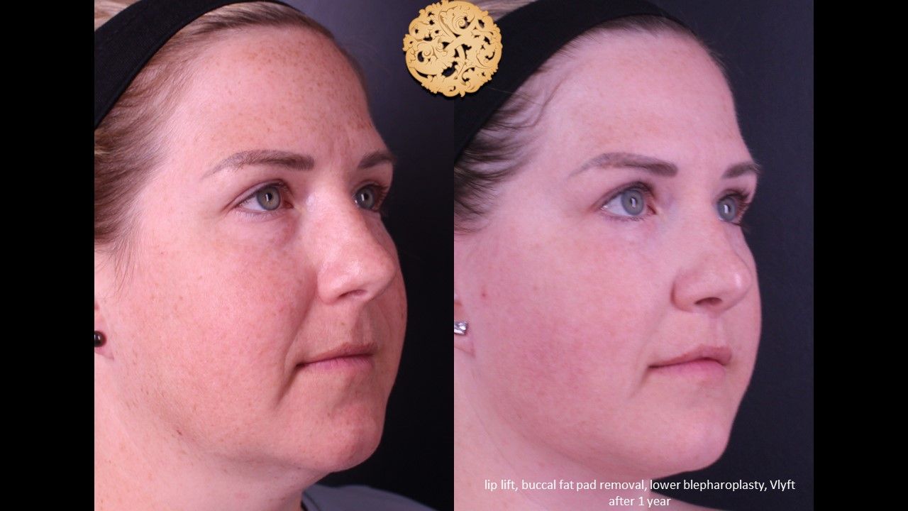 Blepharoplasty Before & After