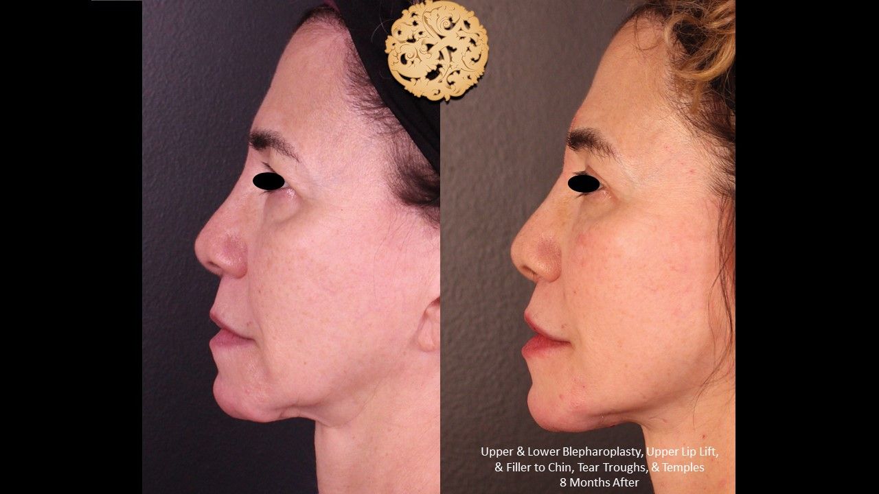 Blepharoplasty Before & After