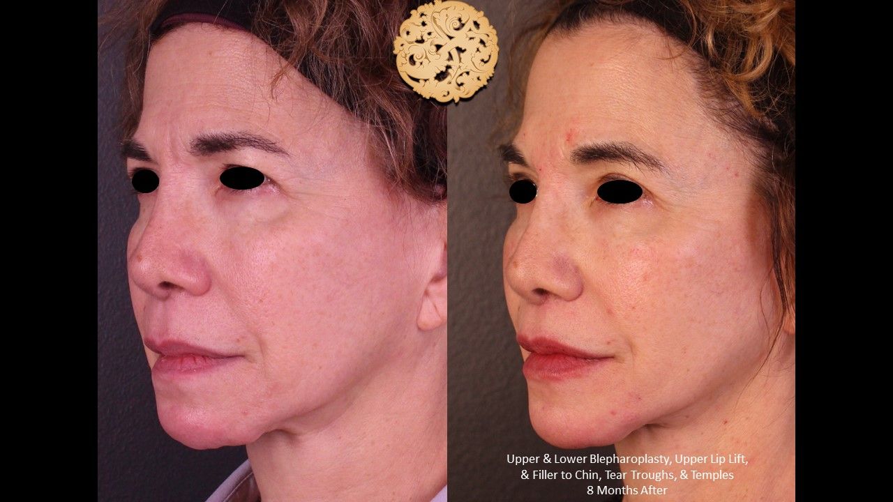 Blepharoplasty Before & After