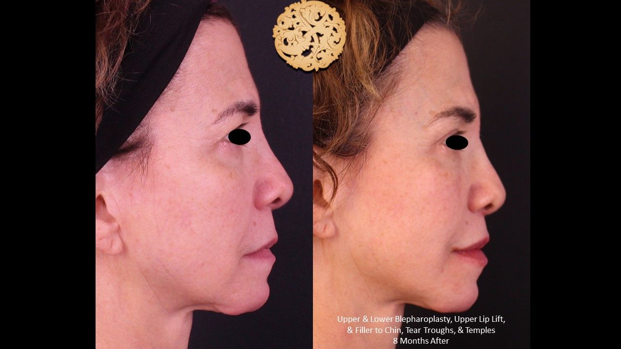 Blepharoplasty Before & After