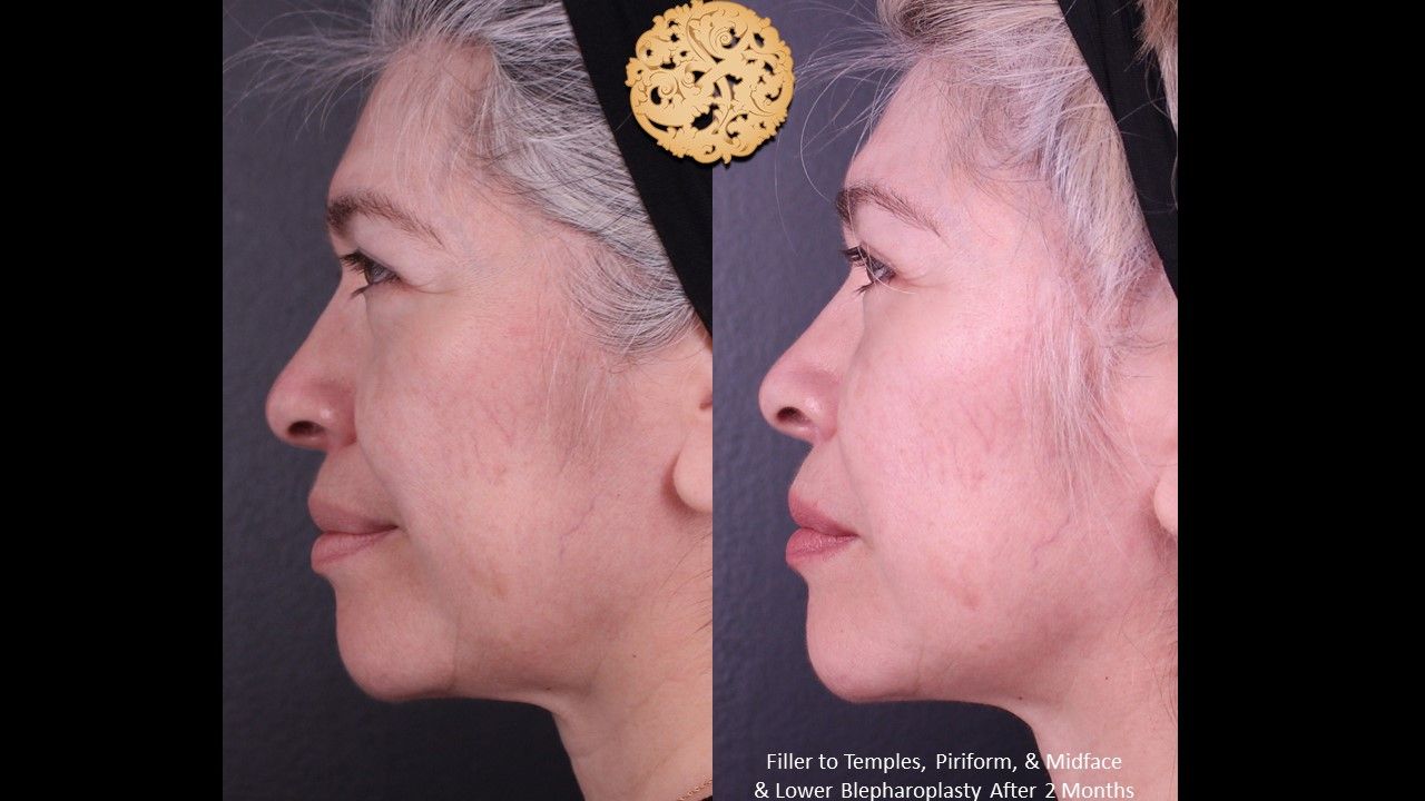 Blepharoplasty Before & After