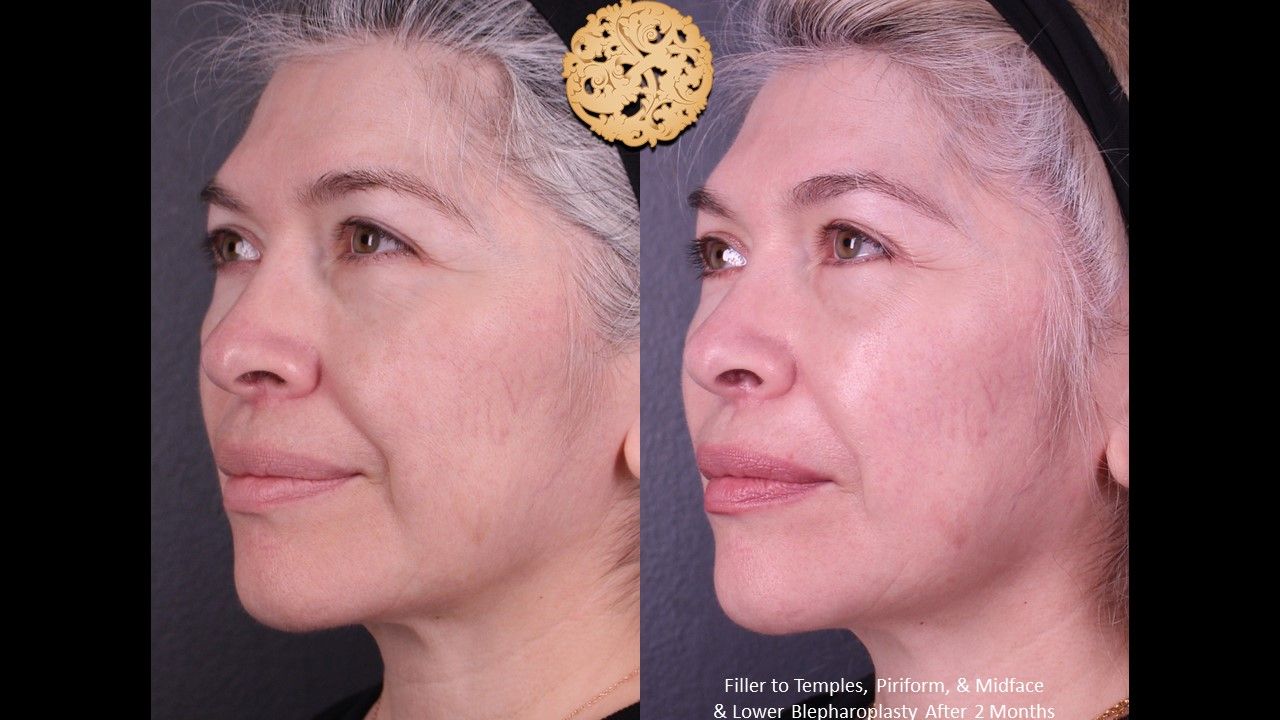 Blepharoplasty Before & After
