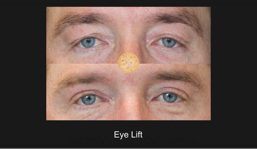 Blepharoplasty Before & After