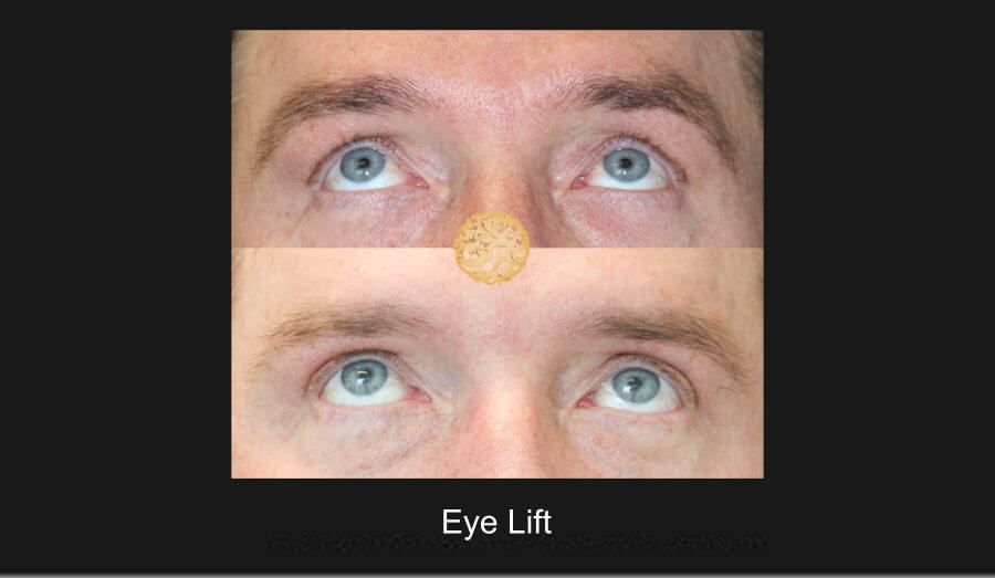 Blepharoplasty Before & After
