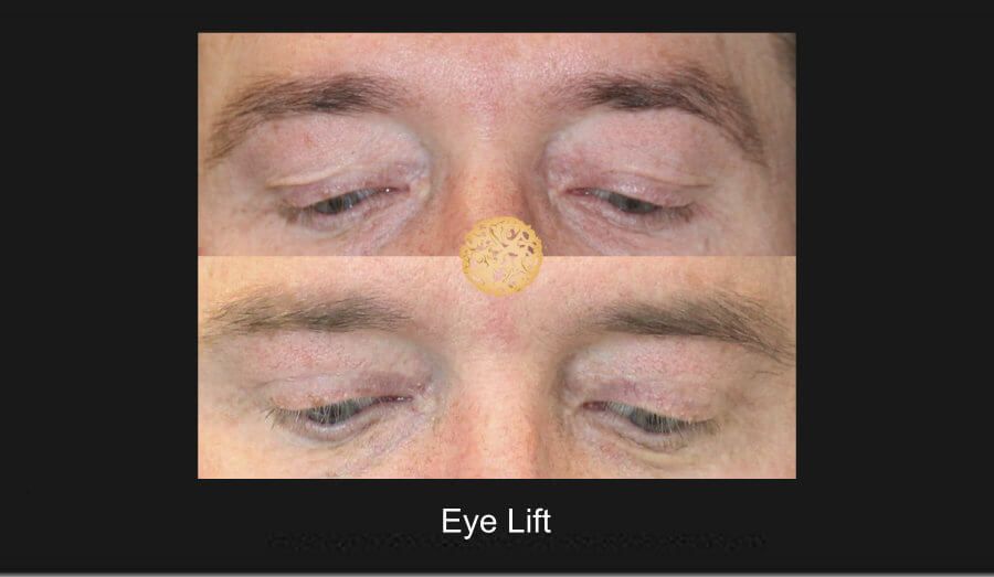 Blepharoplasty Before & After