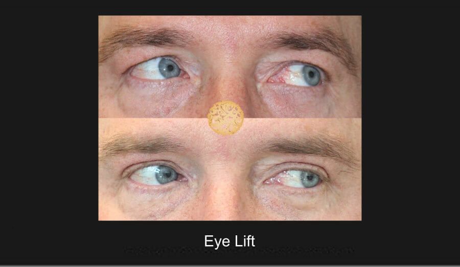 Blepharoplasty Before & After