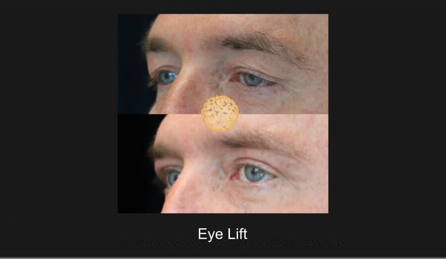 Blepharoplasty Before & After