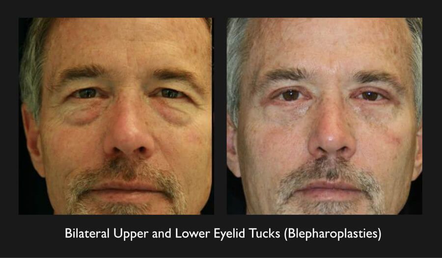 Blepharoplasty Before & After