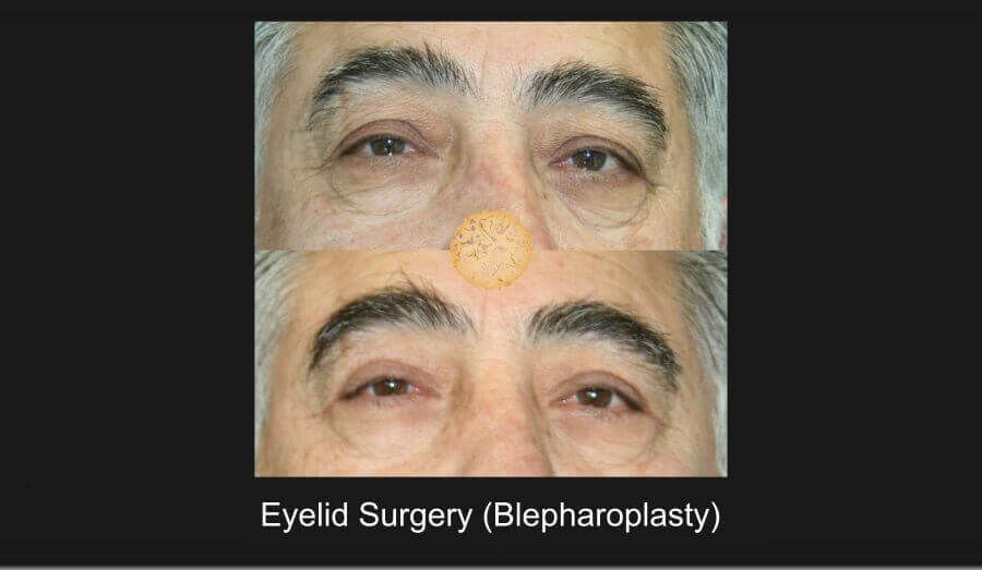 Blepharoplasty Before & After