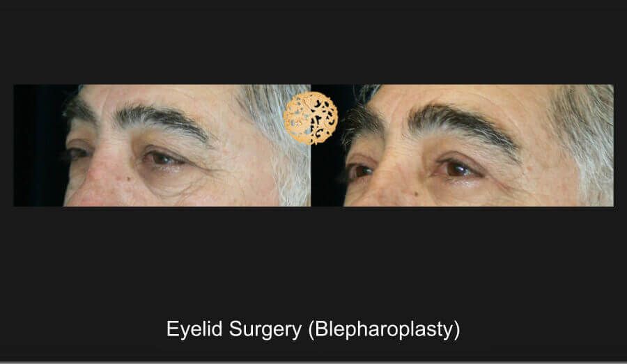 Blepharoplasty Before & After