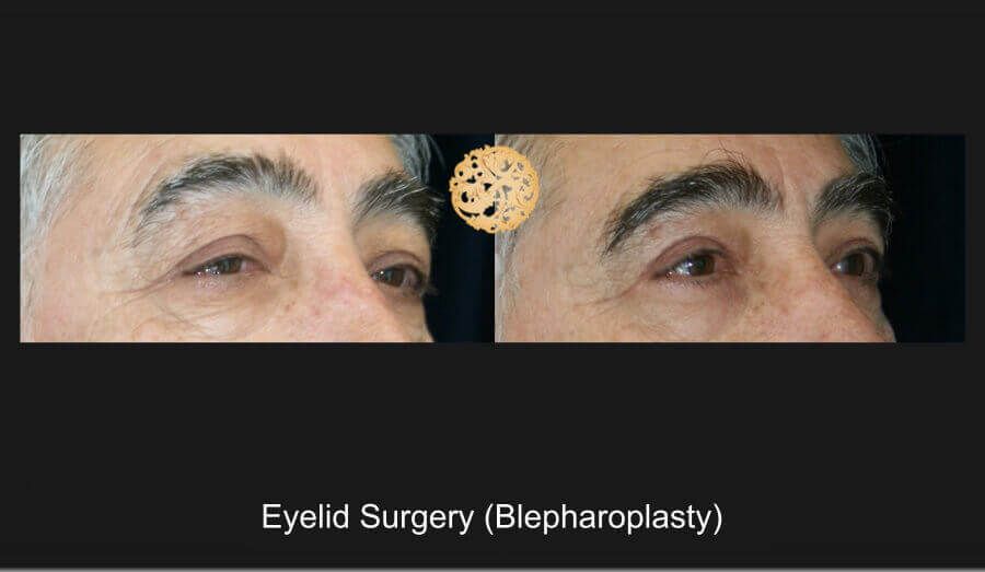 Blepharoplasty Before & After
